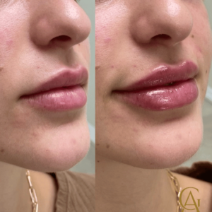 Lip-Enhancement..png