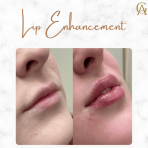 Lip-Filler-Enhancement.png